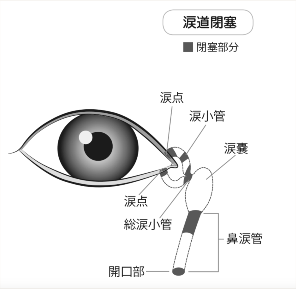 眼科 医が解説 流涙症 涙目 I 横浜けいあい眼科 和田町院